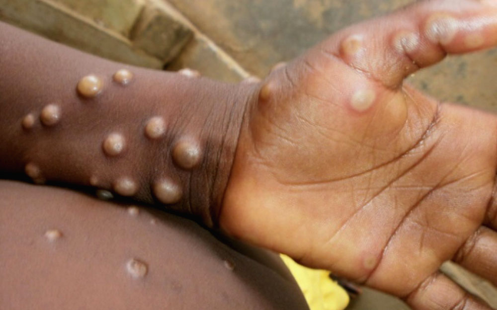 What is monkeypox and why is it a global health concern?