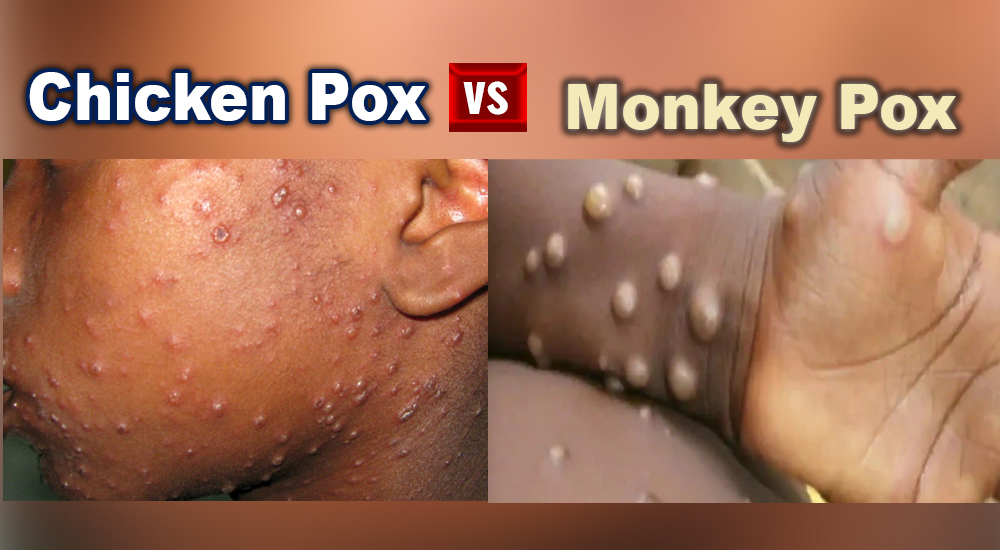 Causes of monkey pox and chicken pox